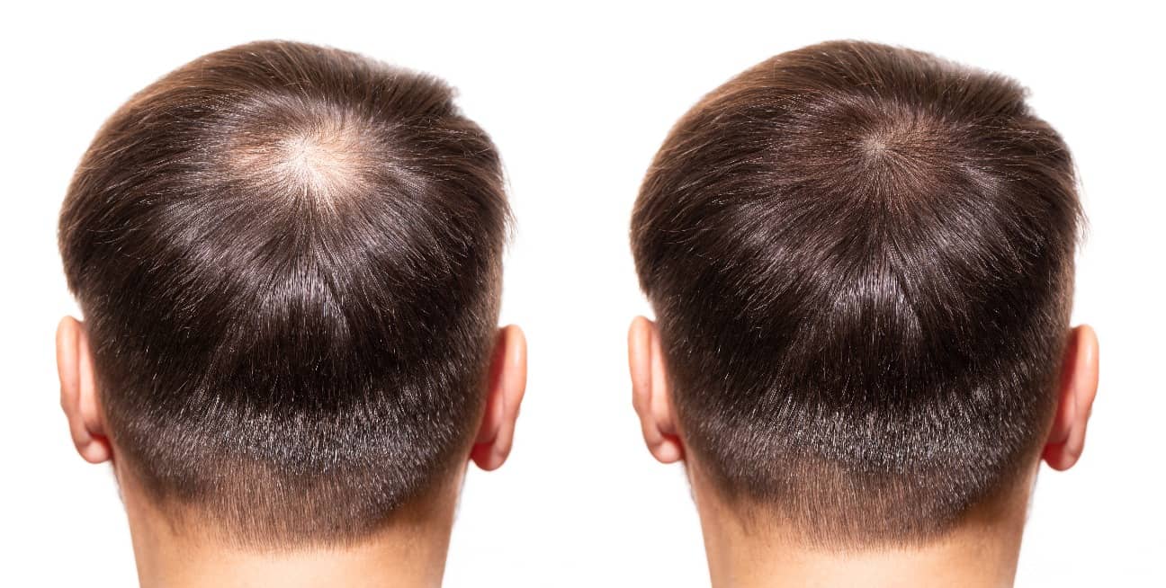 Jak obnovit růst vlasů v koutech?