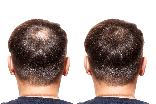 Proč se vyskytuje vypadávání vlasů u mužů i u žen? Diskuze leccos napoví obrázek 5